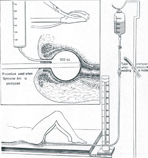 Figure 1 from THE EVOLUTION OF ANORECTAL MANOMETRY | Semantic Scholar