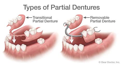 Removable Dentures | Dr. Charles Picchioni | Bryn Mawr PA