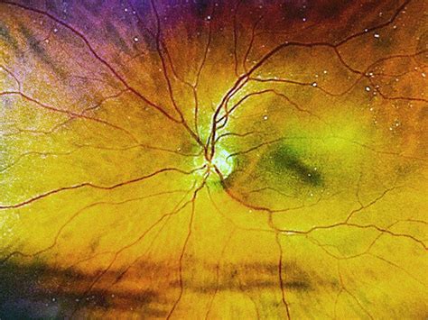 What are the different stages of diabetic retinopathy?