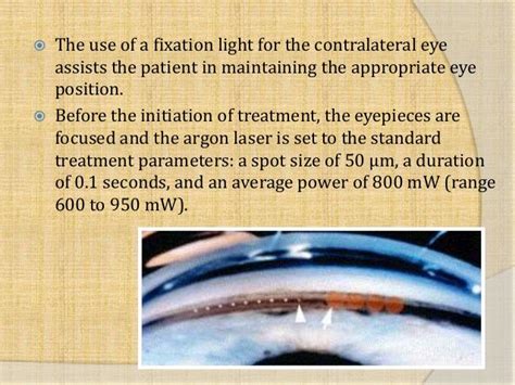 Argon laser