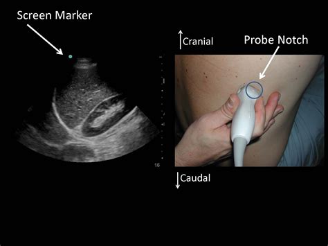 Thoracentesis Landmark