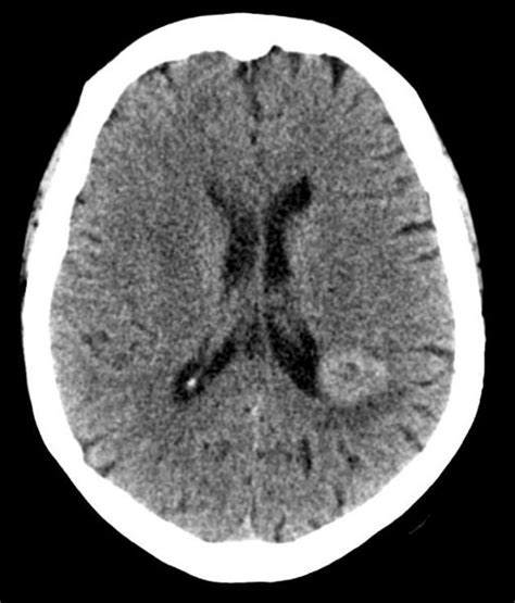 Brain tumor - wikidoc