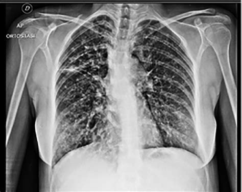 28-year-old girl (F508del/F508del) with cystic fibrosis. Chest X ray ...