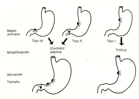 Curling Vs Cushing Ulcer - Pathogenesis Of Diseases Of The Stomach Ppt Video Online Download ...