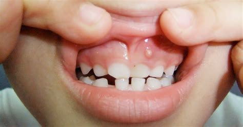 What are Gum Boils and Causes How Can They Be Treated?