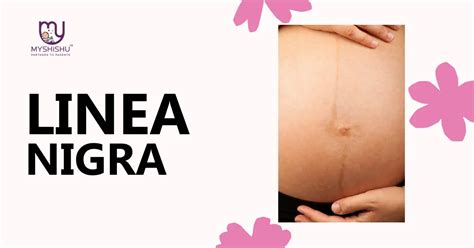 Linea Nigra In Pregnancy: A Comprehensive Guide - MyShishu