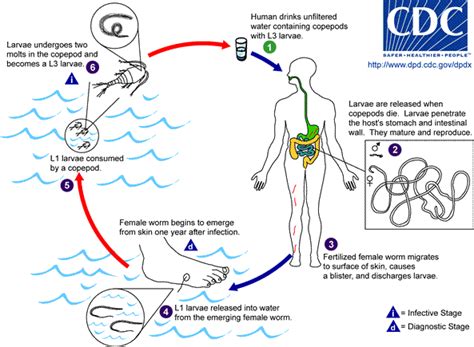 Dracunculiasis (Guinea Worm Disease) Causes, Symptoms, Preventions ...