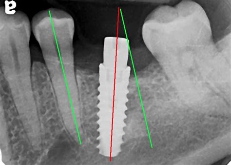 Implant-Related Complications | Implant-Related Complications - Kazemi ...