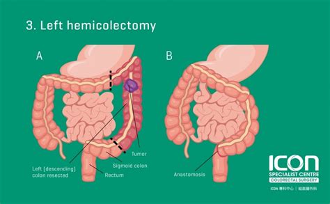 Colorectal resection (colectomy) — Icon Specialist Centre