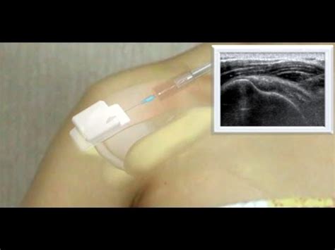 Ultrasound guided Subacromial bursa Injection - YouTube