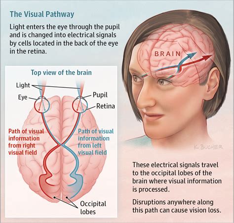 Sudden Vision Loss | Ophthalmology | JAMA | JAMA Network