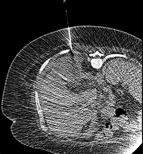 Percutaneous CT guided drainage of the perinephric abscess. | Download ...