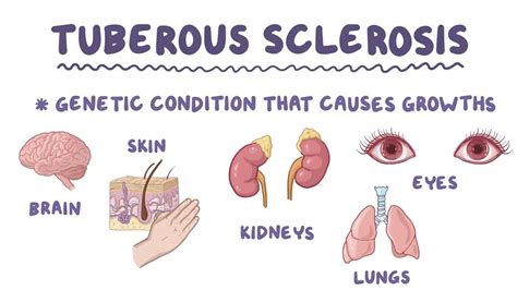 Tuberous sclerosis,what to know?