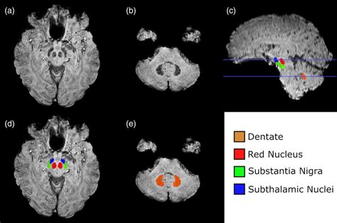 Dentate, red nucleus, substantia nigra, subthalamic nuclei visible as... | Download Scientific ...