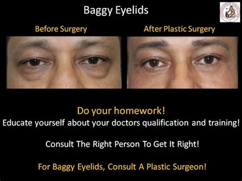 Baggy Eyes Blepharoplasty Eyelid Surgery at best price in Aurangabad | ID: 2849671560673