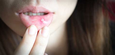 Mouth Ulcers: Causes & Treatments - Dental Studio