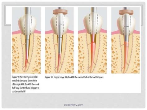 Techniques of Root Canal Obturation