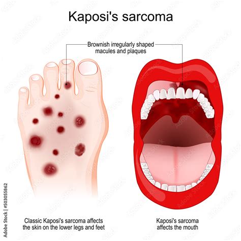 Kaposi's sarcoma. cancer. skin lesions Stock Vector | Adobe Stock