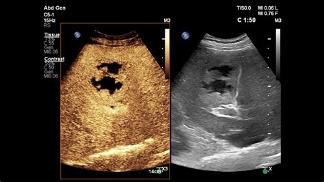 Liver ultrasound systems | Philips Healthcare