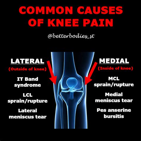 💥 MEDIAL & LATERAL KNEE PAIN 💥