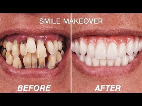 Before & After Smile Makeover Transformations | Cosmetic Dentistry Dental Boutique - YouTube