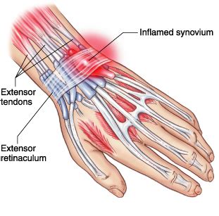 Case Study - Wrist Tendonitis - Boston Chinese Acupuncture