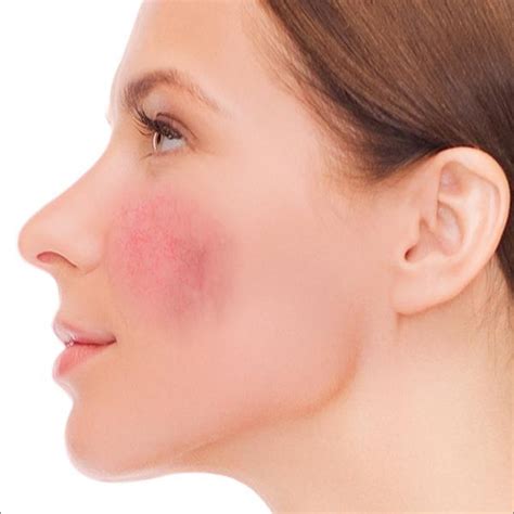 Facial redness - Laser Clinic Galway