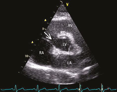 Figure 031_2274. Transthoracic echocardiography (TTE), parasternal ...