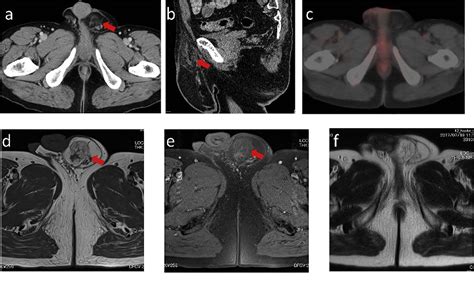 Figure 1 from Liposarcoma of the spermatic cord associated with scrotum ...