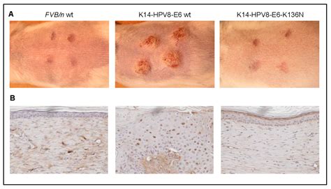 Viruses | Free Full-Text | Molecular Mechanisms of Human Papillomavirus Induced Skin Carcinogenesis