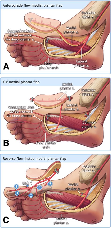 Systematic reappraisal of the reverse-flow medial plantar flap: From vascular anatomical ...