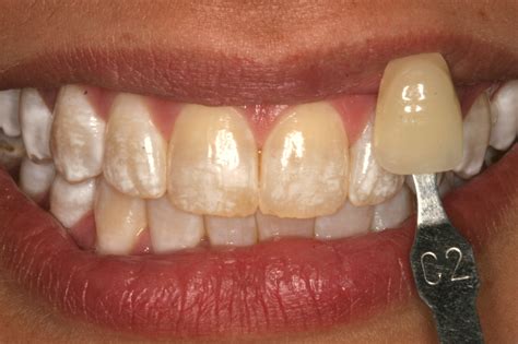 Seeing is Believing - Amazing KöR Whitening Results