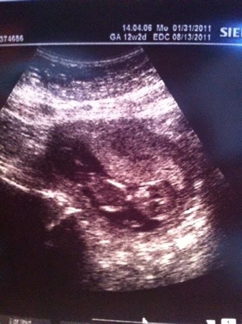 TheWheelerBunch: First Trimester 12 Week Ultrasound Nuchal translucency (NT) scan!