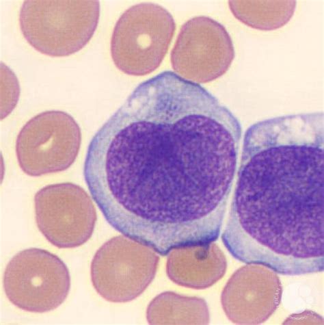 Promonocytes | Hematology, Medical laboratory science, Medical laboratory