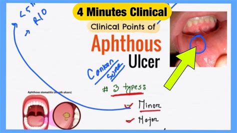 Aphthous Ulcer Explained Like Water | Symptoms Pathophysiology Treatment | Bengali Medicine ...