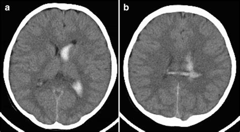 Initial computed tomographic images showing intraventricular hemorrhage... | Download Scientific ...