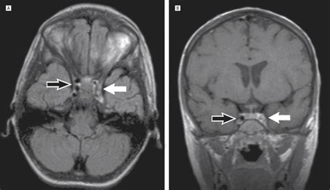 Rhino-orbital Mucormycosis Causing Cavernous Sinus and Internal Carotid Thrombosis Treated With ...