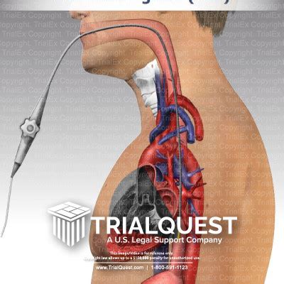 Transesophageal Echocardiogram (TEE) - TrialExhibits Inc.