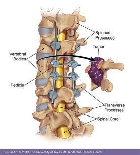 Spinal Cancer Tumor - CancerWalls