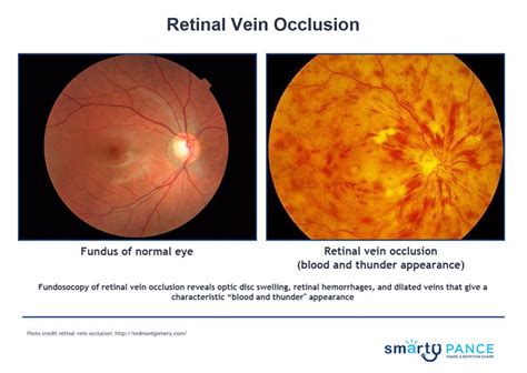 Retinal Vascular Occulsion | EENT Content Blueprint - Smarty PANCE | PANRE