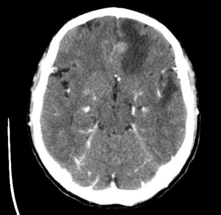 Vasogenic cerebral edema | Radiology Reference Article | Radiopaedia.org