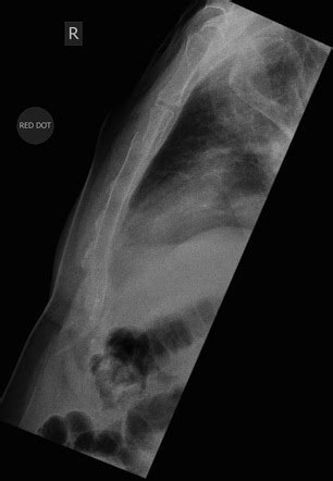 Sternal Fracture X Ray