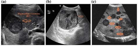 Liver Cancer Ultrasound