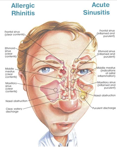 Sinusitis . Sinus anatomy | Allergic rhinitis, Sinusitis, Acute sinusitis