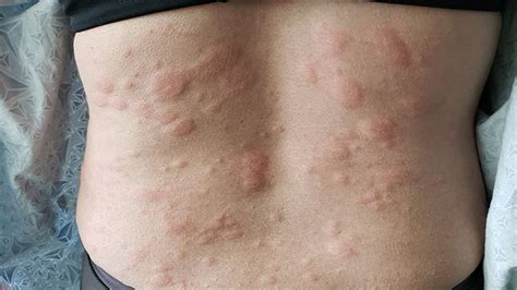 Hives Symptoms: How You Know It’s Really Hives | Everyday Health