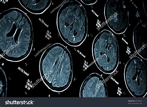 Brain Mri Scan Image For Medical Diagnosis Stock Photo 20105620 ...