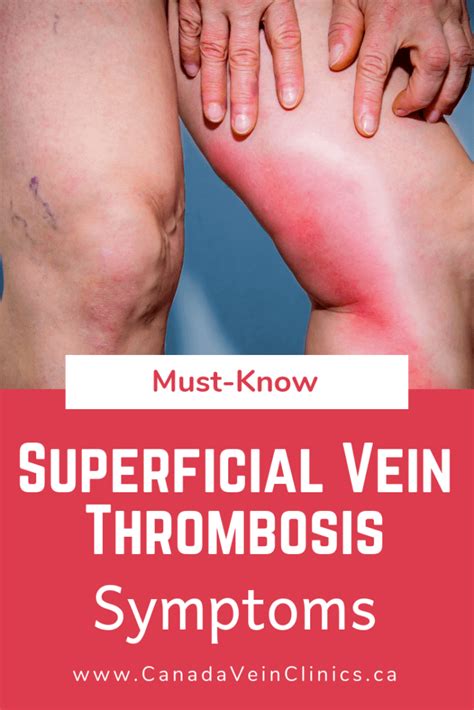 Superficial Vein Thrombosis | Complications of Varicose Veins