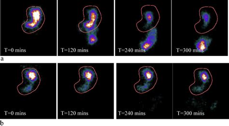 Measurement of gastric emptying in the critically ill - Clinical Nutrition