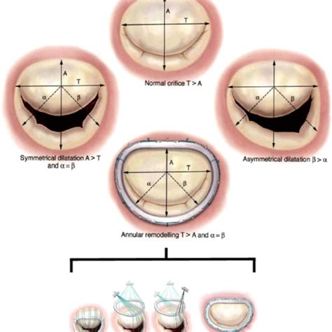 Mitral Valve