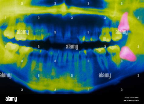 WISDOM TOOTH, X RAY Stock Photo - Alamy